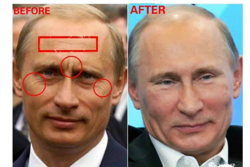 医美成猪皮的普京，不知道习近平做了哪些脸部项目医美成猪皮的普京，不知道习近平做了哪些脸部项目