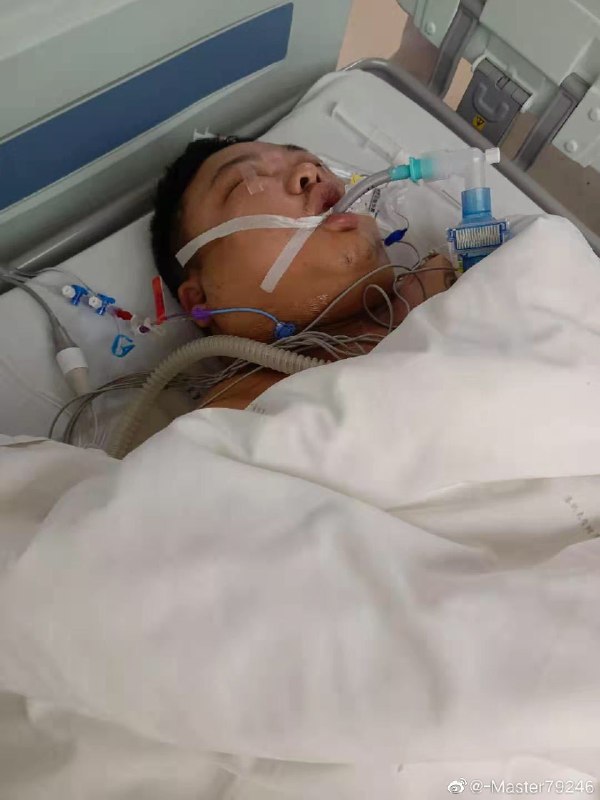 中国悲剧档案 (Twitter)打疫苗，当天就动脉夹层血管撕裂，小肠坏死，还有血栓，进icu！#中国 #共产党 #China #CCP #COVID19 #中国疫情 #新冠病毒 #副作用 👇👇👇👇中国悲剧档案 (Twitter)打疫苗，当天就动脉夹层血管撕裂，小肠坏死，还有血栓，进icu！#中国 #共产党 #China #CCP #COVID19 #中国疫情 #新冠病毒 #副作用 👇👇👇👇