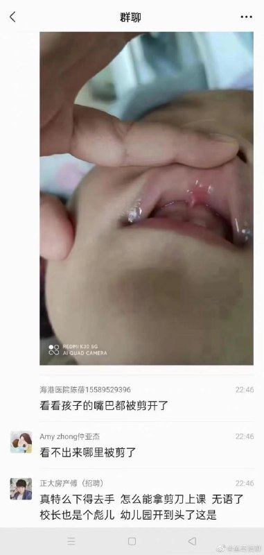 中国出现大型虐童事件， 一天剪了二十个小孩嘴巴丸崽@9_jfm (twitter)中国出现大型虐童事件， 一天剪了二十个小孩嘴巴丸崽@9_jfm (twitter)