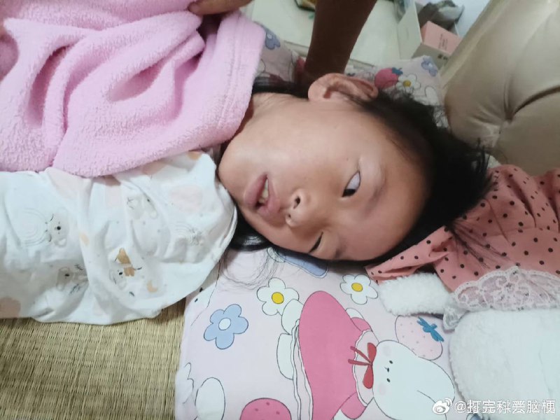 打科兴疫苗脑梗By